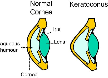 What is keratoconus