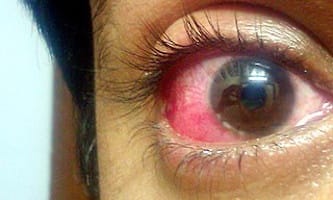 Coronavirus eye symptoms